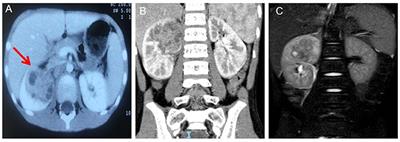 Case report: Localized xanthogranulomatous pyelonephritis in children: A case report and literature review